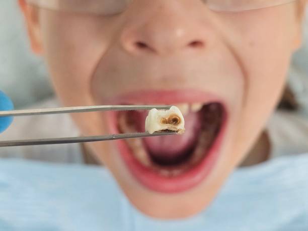 Best Knocked-Out Tooth (Avulsed Tooth) Treatment in Marlborough, MO
